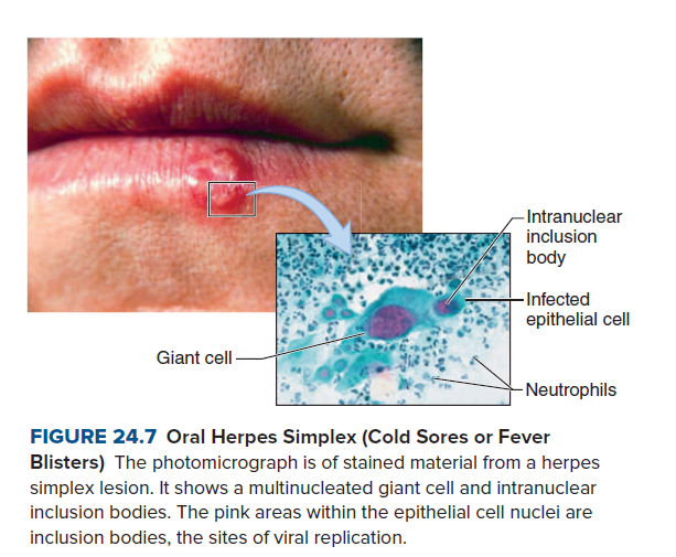 -Intranuclear
inclusion
body
- Infected
epithelial cell
Giant cell
-Neutrophils
FIGURE 24.7 Oral Herpes Simplex (Cold Sores or Fever
Blisters) The photomicrograph is of stained material from a herpes
simplex lesion. It shows a multinucleated giant cell and intranuclear
inclusion bodies. The pink areas within the epithelial cell nuclei are
inclusion bodies, the sites of viral replication.
