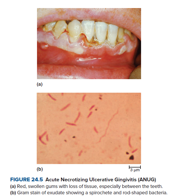 (a)
(b)
3 um
FIGURE 24.5 Acute Necrotizing Ulcerative Gingivitis (ANUG)
(a) Red, swollen gums with loss of tissue, especially between the teeth.
(b) Gram stain of exudate showing a spirochete and rod-shaped bacteria.
