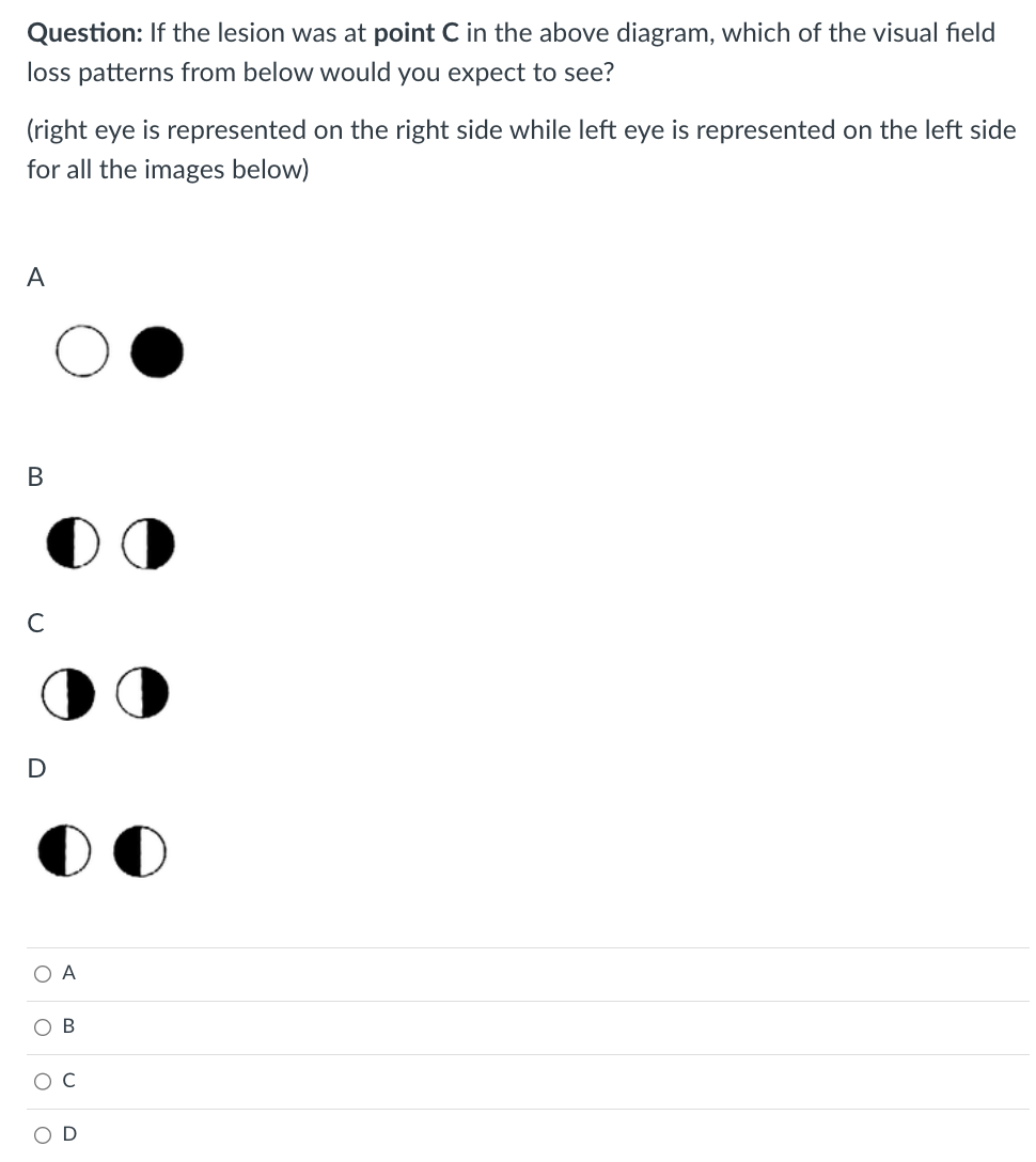 Question: If the lesion was at point C in the above diagram, which of the visual field
loss patterns from below would you expect to see?
(right eye is represented on the right side while left eye is represented on the left side
for all the images below)
A
B
с
D
O A
OB
O C
O