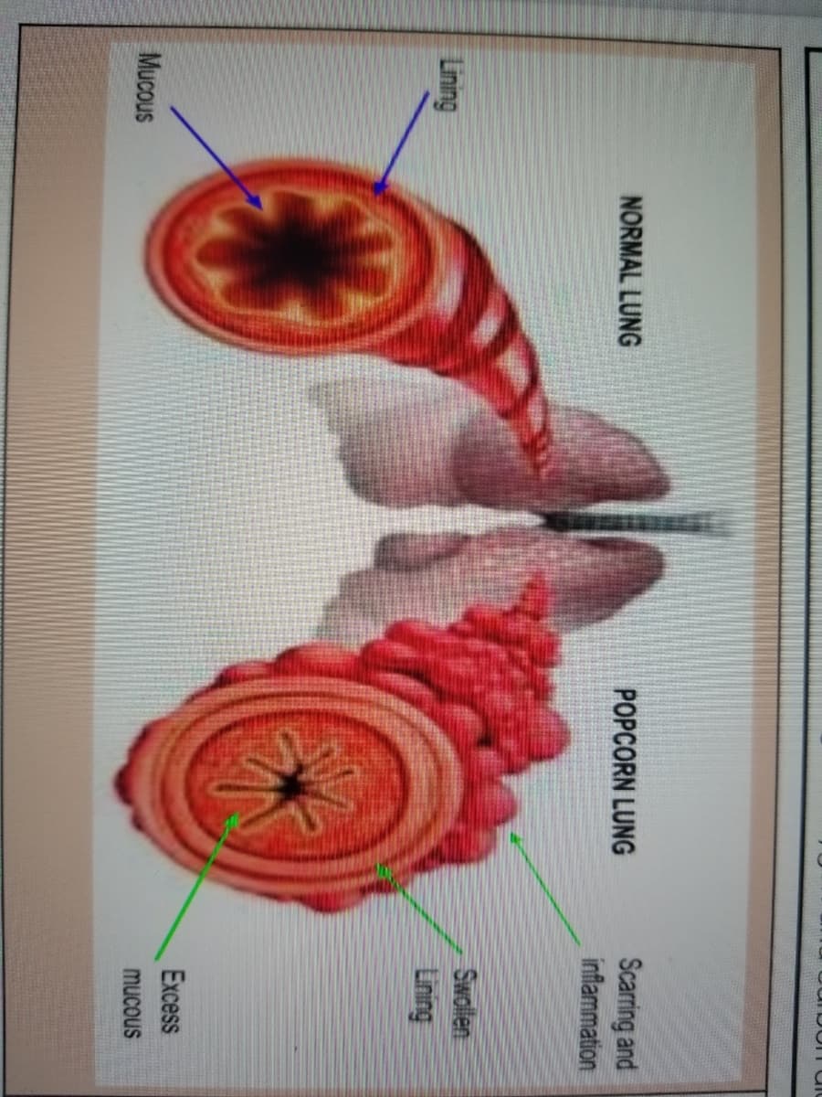 Scarring and
inflammation
NORMAL LUNG
POPCORN LUNG
Swollen
Lining
Lining
Excess
Mucous
mucous
