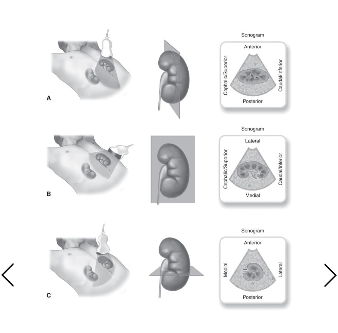 Sonogram
Anterior
Posterior
Sonogram
Lateral
в
Medial
Sonogram
Anterior
Posterior
Medial
Cephalic/Superior
Cephalic/Superior
Lateral
Caudal/Inferior
Caudal/Inferior
