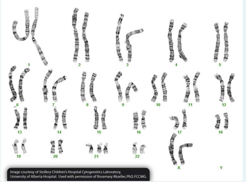 3
5
7
10
11
12
13
14
15
16
17
18
19
20
21
22
Image courtesy of Stollery Children's Hospital Cytogenetics Laboratory,
University of Alberta Hospital. Used with permission of Rosemary Mueller, PhD. FCCMG.
