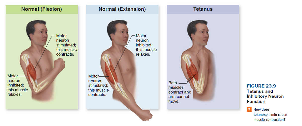 Normal (Flexion)
Normal (Extension)
Tetanus
Motor
Motor
neuron
neuron
stimulated;
this muscle
inhibited;
this muscle
contracts.
relaxes.
Motor
Motor-
neuron
stimulated;
this muscle
contracts.
neuron
Both
muscles
contract and
inhibited;
FIGURE 23.9
this muscle
Tetanus and
relaxes.
Inhibitory Neuron
Function
arm cannot
move.
? How does
tetanospasmin cause
muscle contraction?
