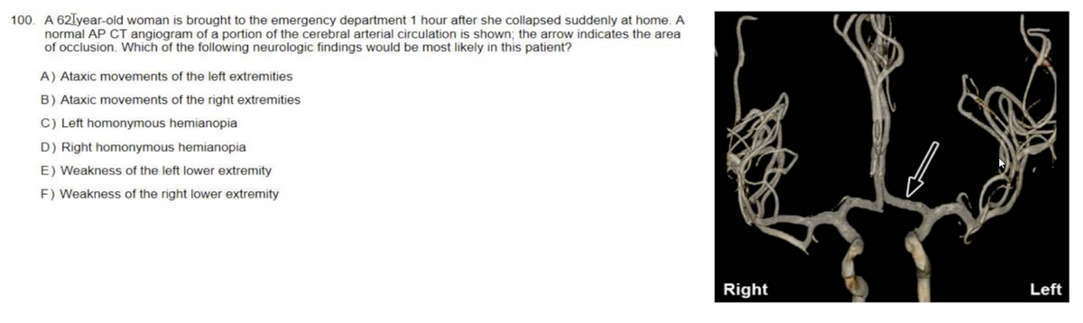 100 A 62łyear-old woman is brought to the emergency department 1 hour after she collapsed suddenly at home. A
normal AP CT angiogram of a portion of the cerebral arterial circulation is shown; the arrow indicates the area
of occlusion. Which of the following neurologic findings would be most likely in this patient?
A) Ataxic movements of the left extremities
B) Ataxic movements of the right extremities
C) Left homonymous hemianopia
D) Right homonymous hemianopia
E) Weakness of the left lower extremity
F) Weakness of the right lower extremity
Right
Left