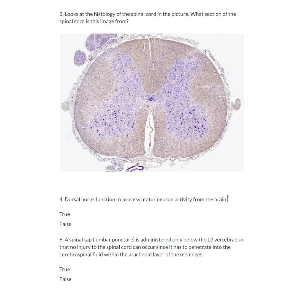 3. Looks at the histology of the spinal cord in the picture. What section of the
spinal cord is this image from?
4. Dorsal horns function to process motor neuron activity from the brain.
True
False
6. A spinal tap (lumbar puncture) is administered only below the L3 vertebrae so
that no injury to the spinal cord can occur since it has to penetrate into the
cerebrospinal fluid within the arachnoid layer of the meninges.
True
False
