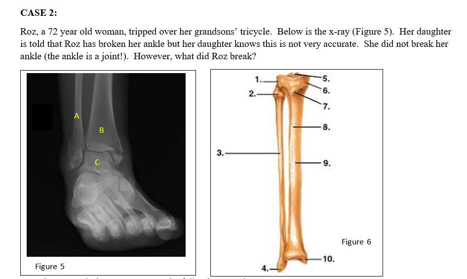 CASE 2:
Roz, a 72 year old woman, tripped over her grandsons' tricycle. Below is the x-ray (Figure 5). Her daughter
is told that Roz has broken her ankle but her daughter knows this is not very accurate. She did not break her
ankle (the ankle is a joint!). However, what did Roz break?
Figure 5
A
B
C
3.
2.-
4.-
-5.
6.
7.
-8.
-9.
10.
Figure 6