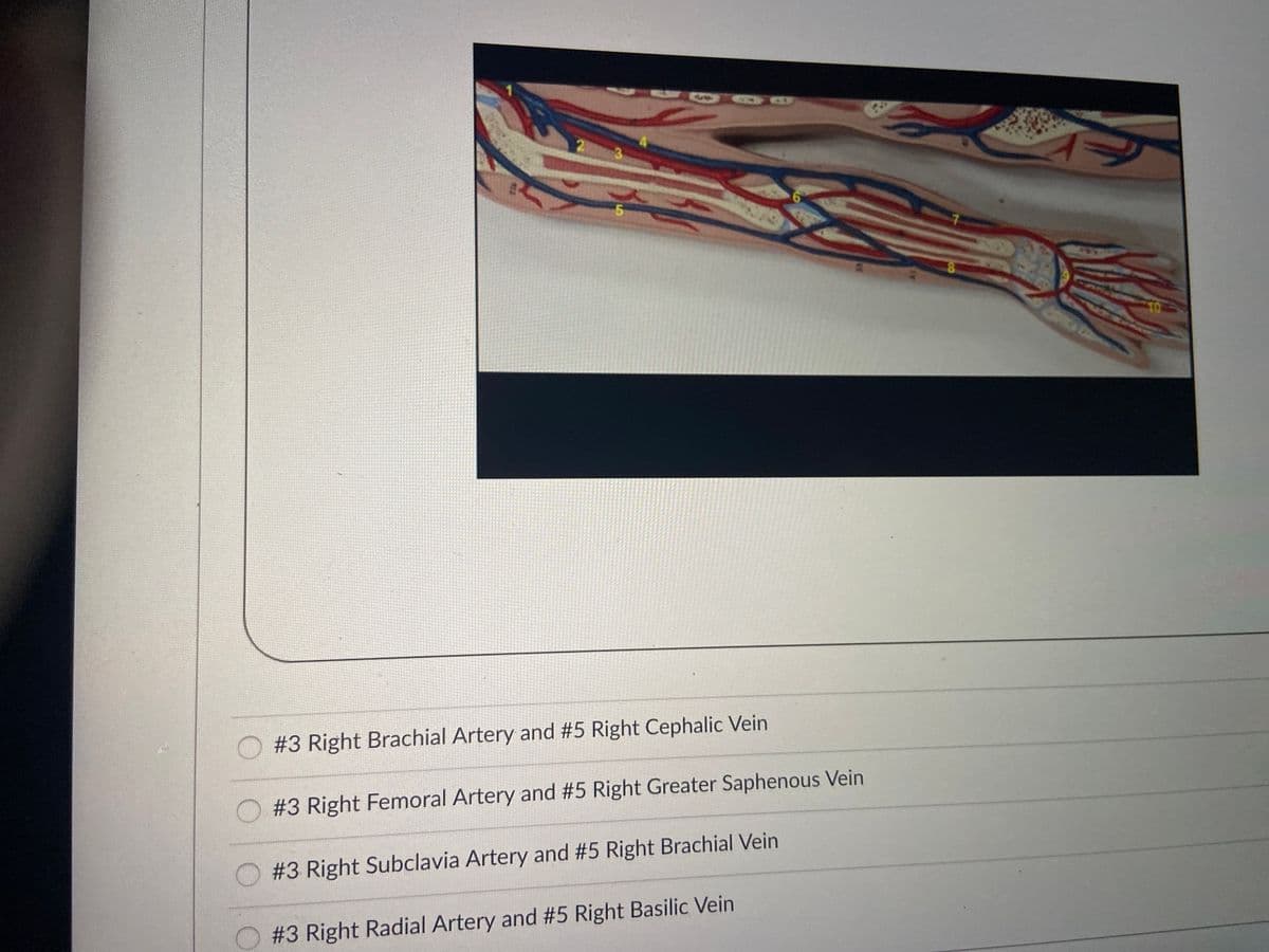 3
TO
#3 Right Brachial Artery and #5 Right Cephalic Vein
#3 Right Femoral Artery and #5 Right Greater Saphenous Vein
#3 Right Subclavia Artery and #5 Right Brachial Vein
#3 Right Radial Artery and #5 Right Basilic Vein
