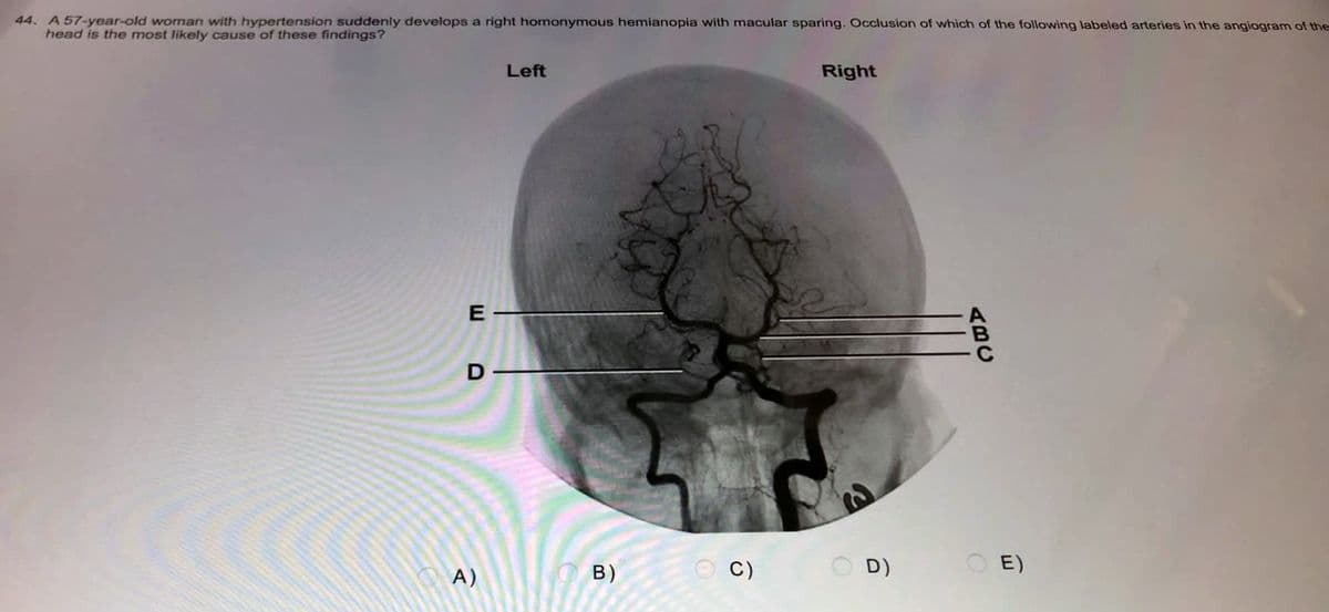 44. A 57-year-old woman with hypertension suddenly develops a right homonymous hemianopia with macular sparing. Occlusion of which of the following labeled arteries in the angiogram of the
head is the most likely cause of these findings?
Left
Right
E-
D-
A)
P
B) C)
O D)
ABC
OE)