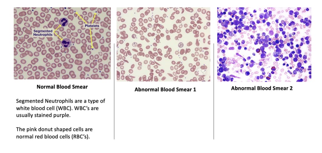 Platelets
Segmented
Neutrophils
Normal Blood Smear
Abnormal Blood Smear 1
Abnormal Blood Smear 2
Segmented Neutrophils are a type of
white blood cell (WBC). WBC's are
usually stained purple.
The pink donut shaped cells are
normal red blood cells (RBC's).
