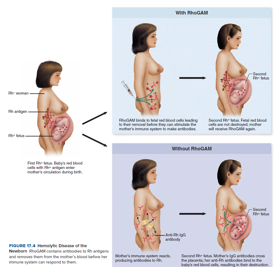 With RhoGAM
-Second
Rh+ fetus
Rh- woman
Rh antigen
RhoGAM binds to fetal red blood cells leading
to their removal before they can stimulate the
mother's immune system to make antibodies.
Second Rh+ fetus. Fetal red blood
cells are not destroyed; mother
will receive RhoGAM
Rh+ fetus
Without RhoGAM
First Rh+ fetus. Baby's red blood
cells with Rh+ antigen enter
mother's circulation during birth.
-Second
Rh+ fetus
-Anti-Rh IgG
antibody
FIGURE 17.4 Hemolytic Disease of the
Newborn RhoGAM contains antibodies to Rh antigens
Mother's immune system reacts,
producing antibodies to Rh.
Second Rh+ fetus. Mother's IgG antibodies cross
the placenta; her anti-Rh antibodies bind to the
baby's red blood cells, resulting in their destruction.
and removes them from the mother's blood before her
immune system can respond to them.
