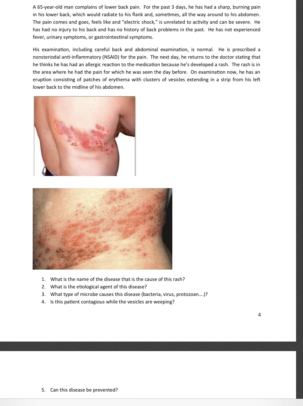 **Case Study: Shingles Presentation and Diagnosis**

A 65-year-old man complains of lower back pain. For the past 3 days, he has had a sharp, burning pain in his lower back, which would radiate to his flank and, sometimes, all the way around to his abdomen. The pain comes and goes, feels like and “electric shock,” is unrelated to activity and can be severe. He has had no injury to his back and has no history of back problems in the past. He has not experienced fever, urinary symptoms, or gastrointestinal symptoms.

His examination, including careful back and abdominal examination, is normal. He is prescribed a nonsteroidal anti-inflammatory (NSAID) for the pain. The next day, he returns to the doctor stating that he thinks he has had an allergic reaction to the medication because he’s developed a rash. The rash is in the area where he had the pain for which he was seen the day before. On examination now, he has an eruption consisting of patches of erythema with clusters of vesicles extending in a strip from his left lower back to the midline of his abdomen.

**Images:**

*Image 1:* This image shows a portion of the patient's back where the rash has developed. There are clusters of red, inflamed patches likely intermixed with vesicles.

![Image showing rash on the patient's back](insertimageurl)

*Image 2:* A close-up image of the rash detailing the distinct clusters of erythema with vesicular formations.

![Close-up of the rash](insertimageurl)

**Questions:**

1. What is the name of the disease that is the cause of this rash?
2. What is the etiological agent of this disease?
3. What type of microbe causes this disease (bacteria, virus, protozoan…)?
4. Is this patient contagious while the vesicles are weeping?
5. Can this disease be prevented?

**Discussion:**

This case study describes the presentation, diagnosis, and management of a patient with shingles (herpes zoster), a viral infection caused by the reactivation of the varicella-zoster virus. The dermatomal rash and painful vesicular eruptions are characteristic of this condition.

**Answers to Questions:**

1. The disease is called Shingles or Herpes Zoster.
2. The etiological agent is the Varicella-Zoster Virus (VZV).
3. VZ