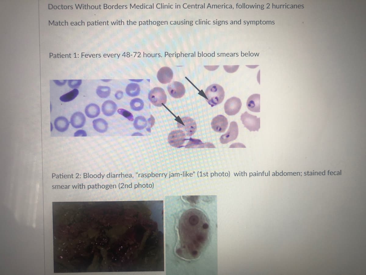 Doctors Without Borders Medical Clinic in Central America, following 2 hurricanes
Match each patient with the pathogen causing clinic signs and symptoms
Patient 1: Fevers every 48-72 hours. Peripheral blood smears below
Patient 2: Bloody diarrhea, "raspberry jam-like" (1st photo) with painful abdomen; stained fecal
smear with pathogen (2nd photo)
