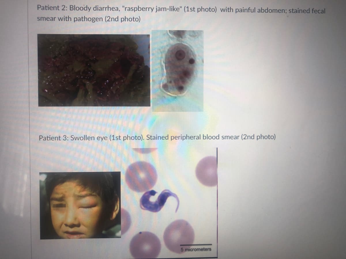 Patient 2: Bloody diarrhea, "raspberry jam-like" (1st photo) with painful abdomen; stained fecal
smear with pathogen (2nd photo)
Patient 3: Swollen eye (1st photo). Stained peripheral blood smear (2nd photo)
5 micrometers
