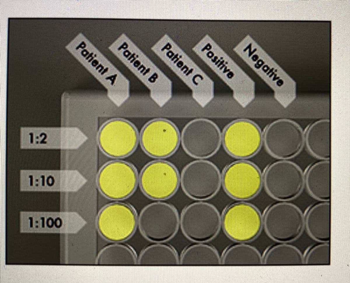 Patient C
Patient B
Patient A
1:2
1:10
1:100
Negative
Positive
