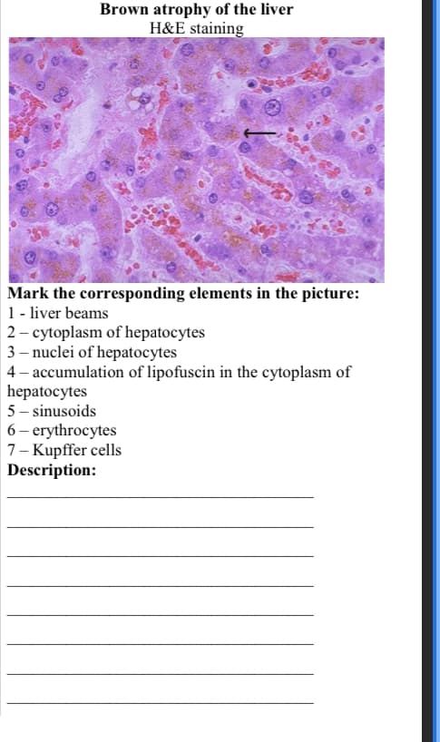 Brown atrophy of the liver
H&E staining
Mark the corresponding elements in the picture:
1 - liver beams
2- cytoplasm of hepatocytes
3-nuclei of hepatocytes
4- accumulation of lipofuscin in the cytoplasm of
hepatocytes
5-sinusoids
6 - erythrocytes
7- Kupffer cells
Description: