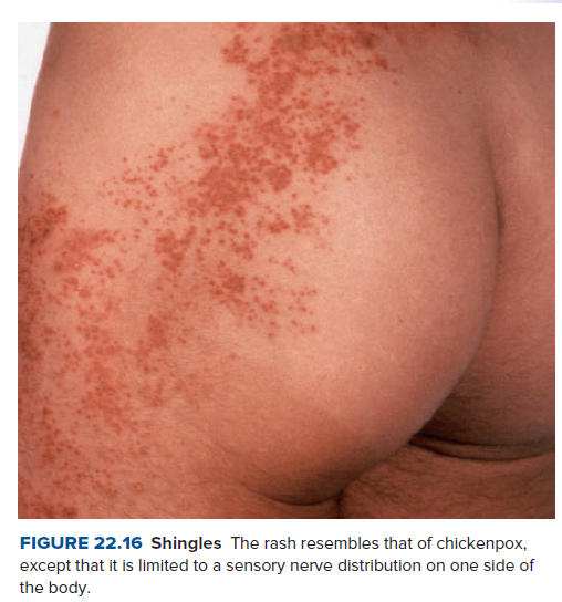 FIGURE 22.16 Shingles The rash resembles that of chickenpox,
except that it is limited to a sensory nerve distribution on one side of
the body.
