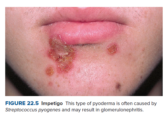 FIGURE 22.5 Impetigo This type of pyoderma is often caused by
Streptococcus pyogenes and may result in glomerulonephritis.
