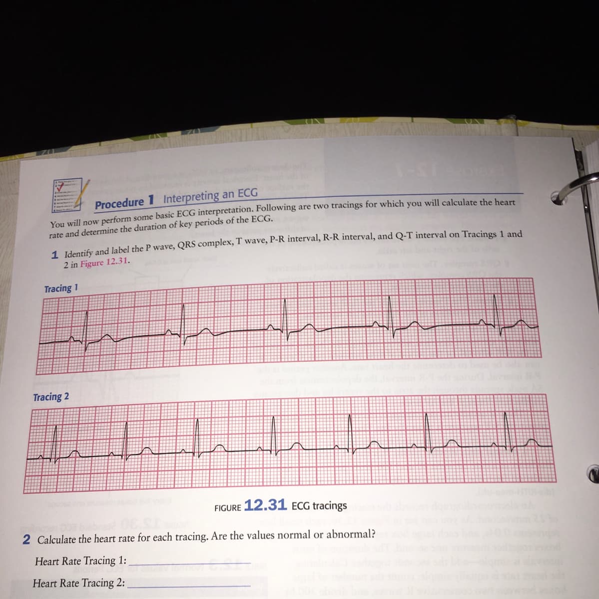 Procedure 1 Interpreting an ECG
You will now perform some basic ECG interpretation. Following are two tracings for which you will calculate the beart
rate and determine the duration of key periods of the ECG.
1. Identify and label the P wave, QRS complex, T wave, P-R interval, R-R interval, and Q-T interval on Tracings 1 and
2 in Figure 12.31.
Tracing 1
Tracing 2
FIGURE 12.31 ECG tracings
2 Calculate the heart rate for each tracing. Are the values normal or abnormal?
Heart Rate Tracing 1:
Heart Rate Tracing 2:
