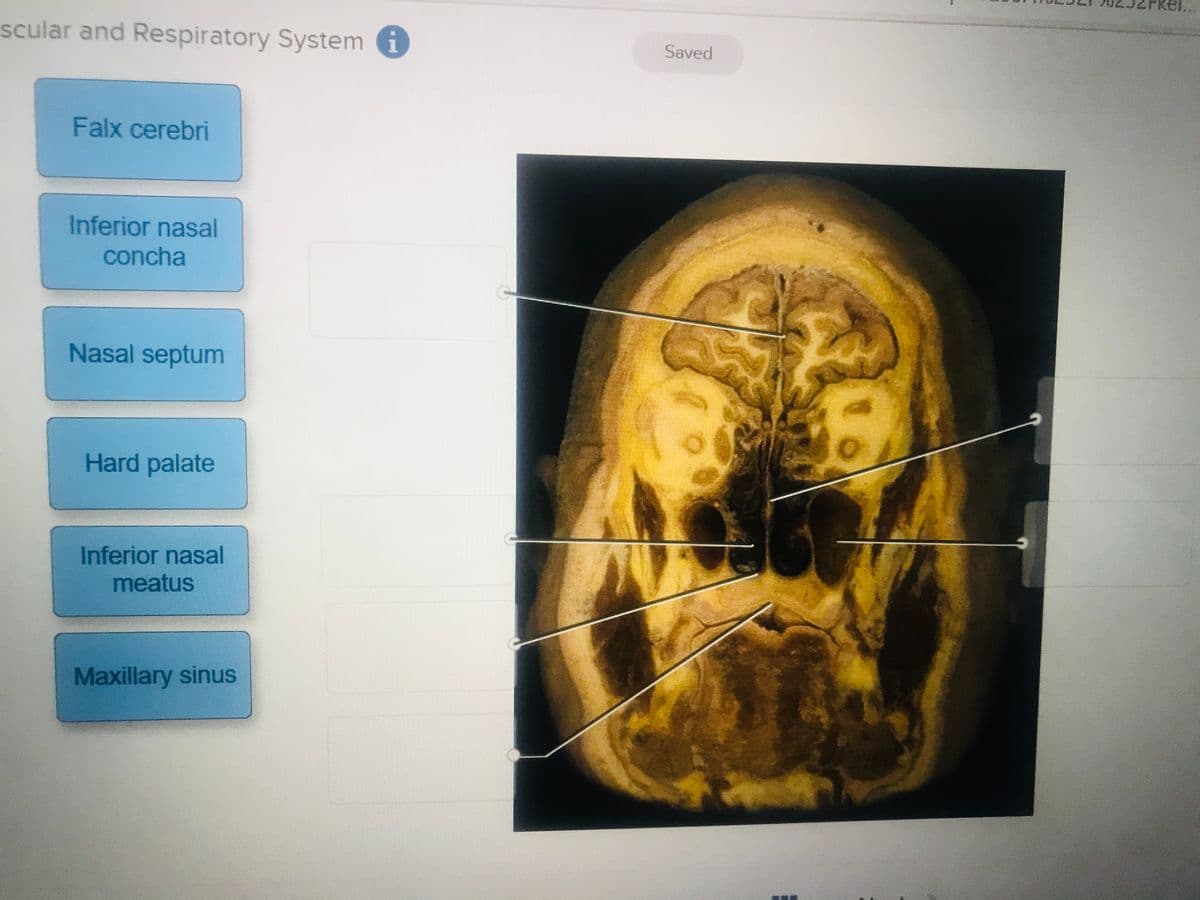 scular and Respiratory System i
Saved
Falx cerebri
Inferior nasal
concha
Nasal septum
Hard palate
Inferior nasal
meatus
Maxillary sinus
