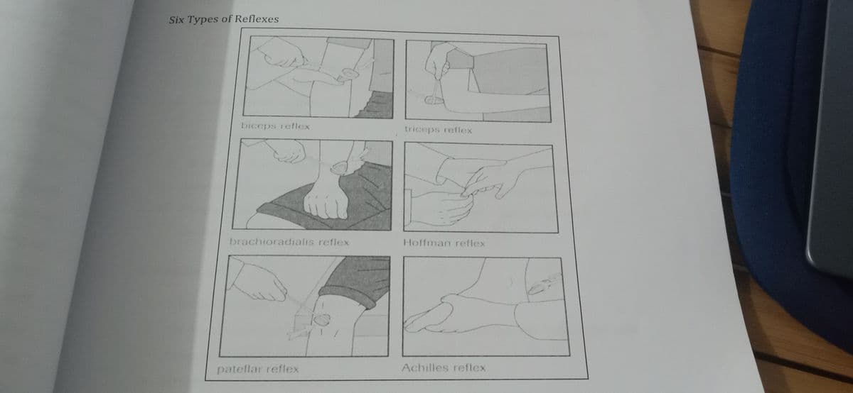 Six Types of Reflexes
biceps reflex
brachioradialis reflex
patellar reflex
triceps reflex
Gr
Hoffman reflex
Achilles reflex