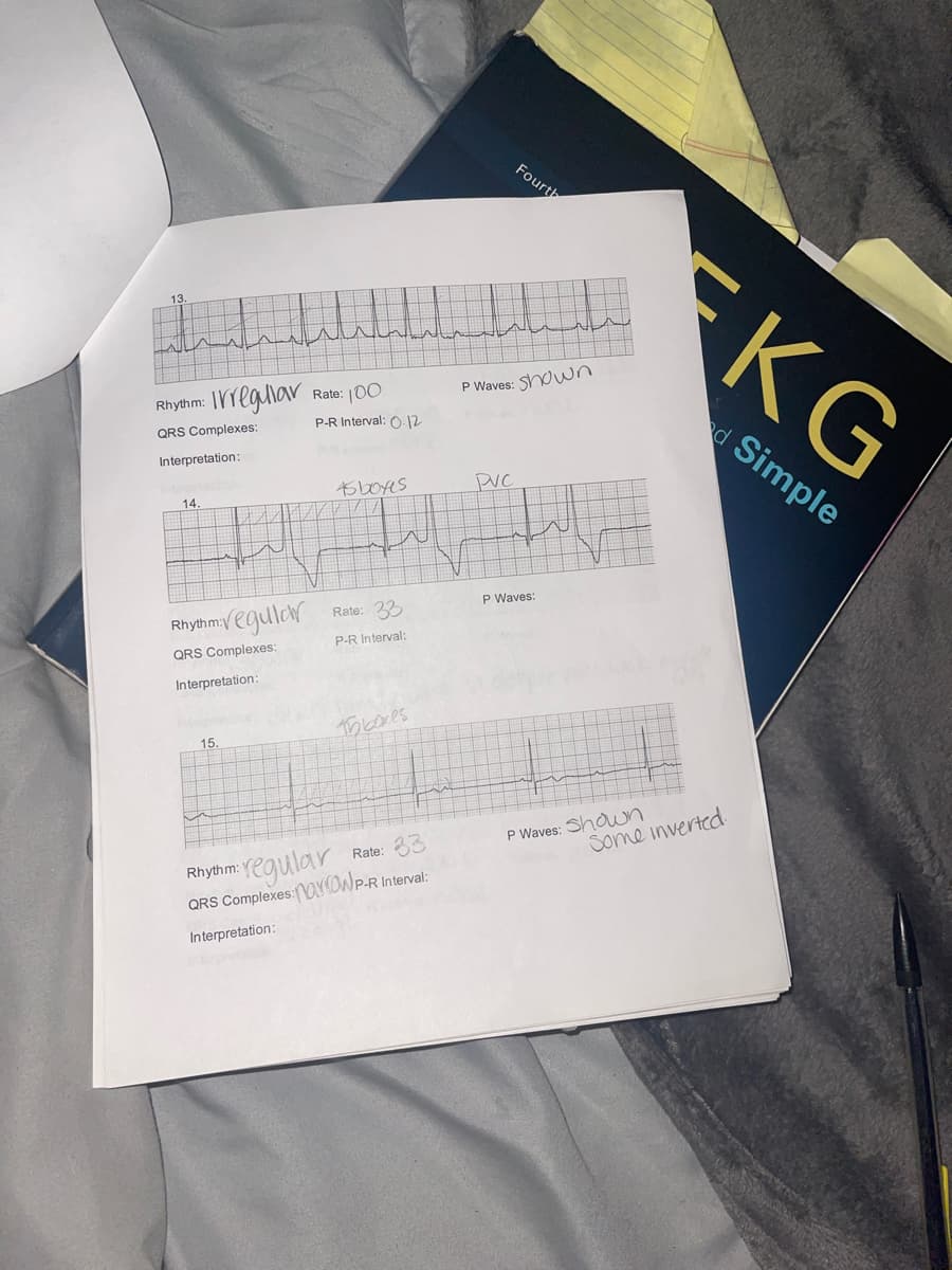 **Understanding and Interpreting EKG Readings**

An Electrocardiogram (EKG) is a test that records the electrical activity of the heart over a period of time. This guide will help you understand and interpret basic EKG readings. Below, you will find three different EKG strips with their associated parameters and interpretations.

### 1. EKG Strip 1
- **Rhythm:** Irregular
- **Rate:** 100 beats per minute (bpm)
- **P Waves:** Shown
- **QRS Complexes:** 
- **P-R Interval:** 0.12 seconds
- **Interpretation:** 

This EKG strip shows an irregular heart rhythm with a heart rate of 100 bpm. The P waves are present, and the P-R interval is within normal limits at 0.12 seconds. The interpretation section for this strip has been left blank, indicating that further analysis may be needed to determine the specific type of arrhythmia present.

### 2. EKG Strip 2
- **Rhythm:** Regular
- **Rate:** 33 bpm
- **P Waves:** 
- **QRS Complexes:** 
- **P-R Interval:** Not specified
- **Interpretation:** 

This EKG strip shows a regular heart rhythm with a significantly low heart rate of 33 bpm. The interpretation notes “5 blocks PVC,” suggesting the presence of premature ventricular contractions (PVCs) occurring every five blocks. 

### 3. EKG Strip 3
- **Rhythm:** Regular
- **Rate:** 83 bpm
- **P Waves:** Shown, some inverted
- **QRS Complexes:** Narrow
- **P-R Interval:** Not specified
- **Interpretation:** 

This EKG strip shows a regular heart rhythm with a heart rate of 83 bpm. The P waves are present, but some are inverted. The QRS complexes are noted to be narrow, which is typically a positive sign indicating that the ventricles are depolarizing normally.

### Summary
This guide illustrates common features and terminology used in EKG interpretation:
- **Rhythm:** Determining whether the heart rhythm is regular or irregular
- **Rate:** Calculating the heart rate in beats per minute
- **P Waves:** Identifying the atrial depolarization
- **QRS Complexes:** Observing ventricular depolarization
- **P-R Interval:** Measuring the time between