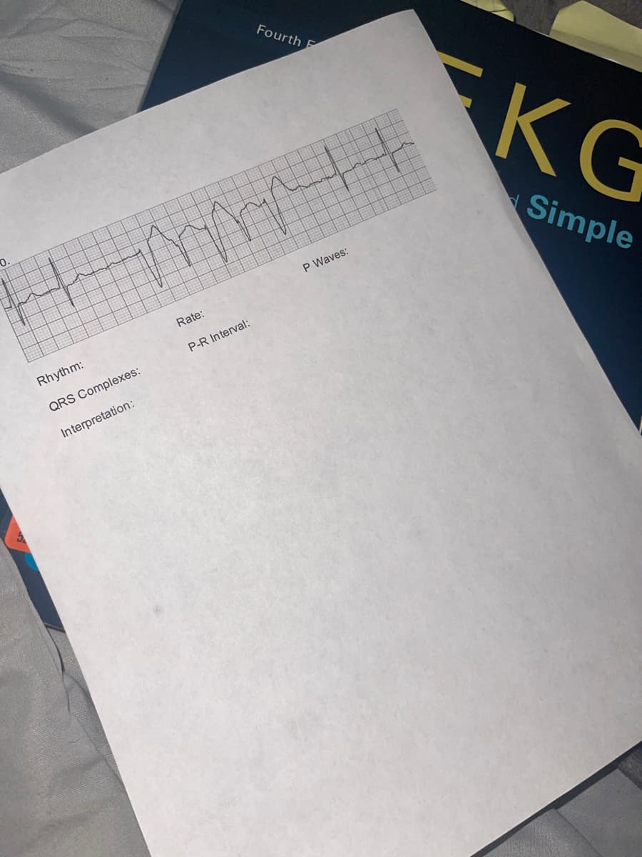 Fourth F
MMMHH
Rate:
P Waves:
P-R Interval:
Rhythm:
QRS Complexes:
Interpretation:
KG
Simple